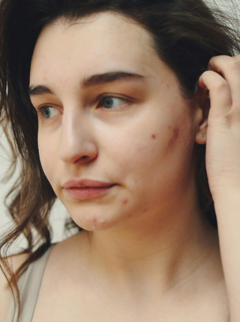 woman with acne tucking hair behind ear