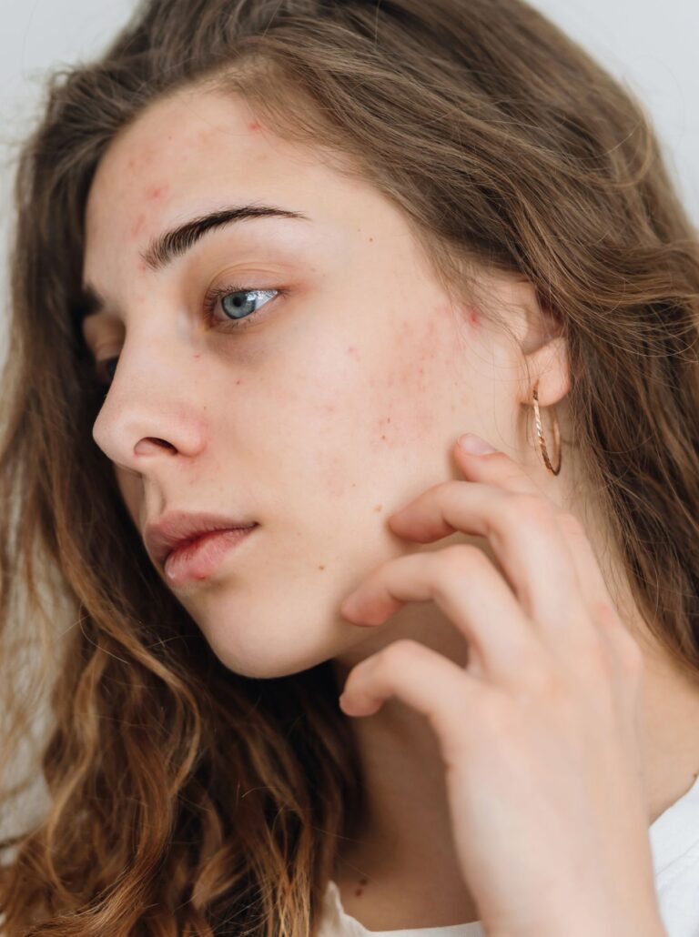 Ultimate Guide to Skin Purging (What Is It and How To Deal With It)