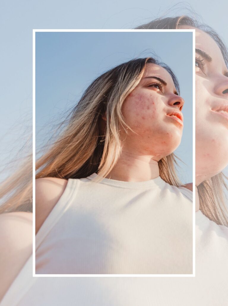 How To Get Rid of Acne Scars and Clear Up Your Skin For Real